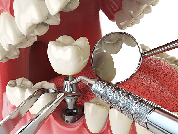 Best Emergency Root Canal Treatment in Patterson, LA